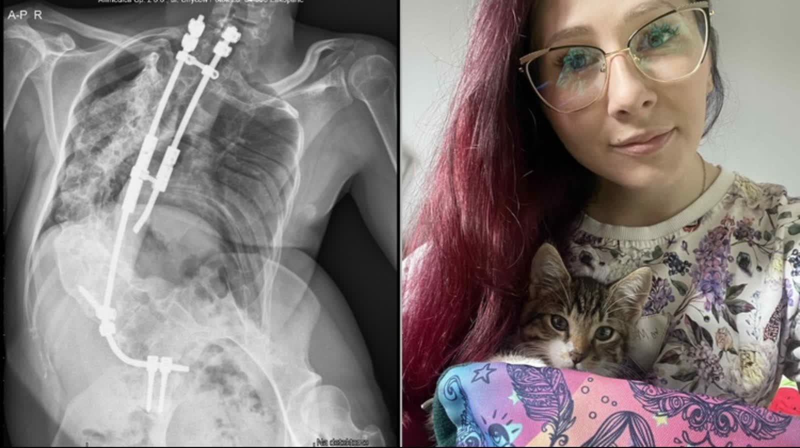 Zuzanna Kowalska walczy o życie bez bólu. Liczy się każda złotówka